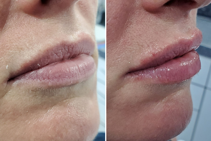 Before and After Juvederm filler treatment near me in Surrey