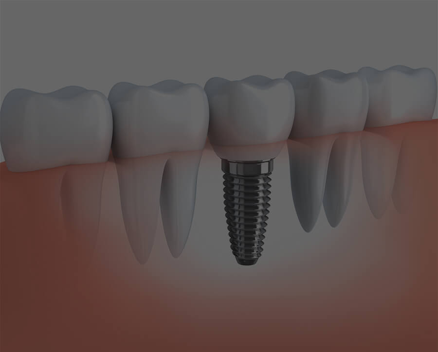 Dental implants near me Surrey